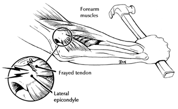 diagram of surgery for tennis elbow